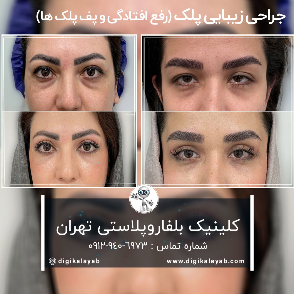 کلینیک بلفاروپلاستی تهران (جراحی زیبایی پلک)
