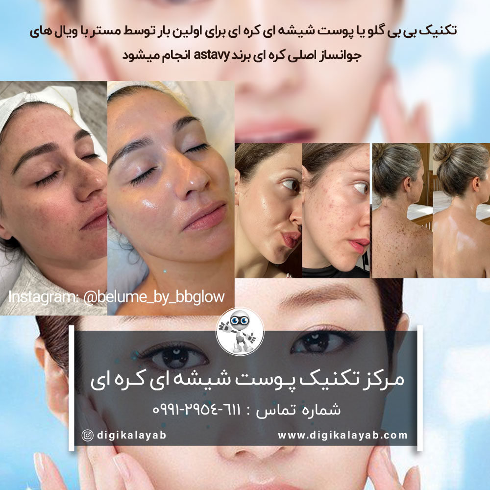 مرکز تکنیک بی بی گلو پوست شیشه ای کره ای در الهیه (فرشته)